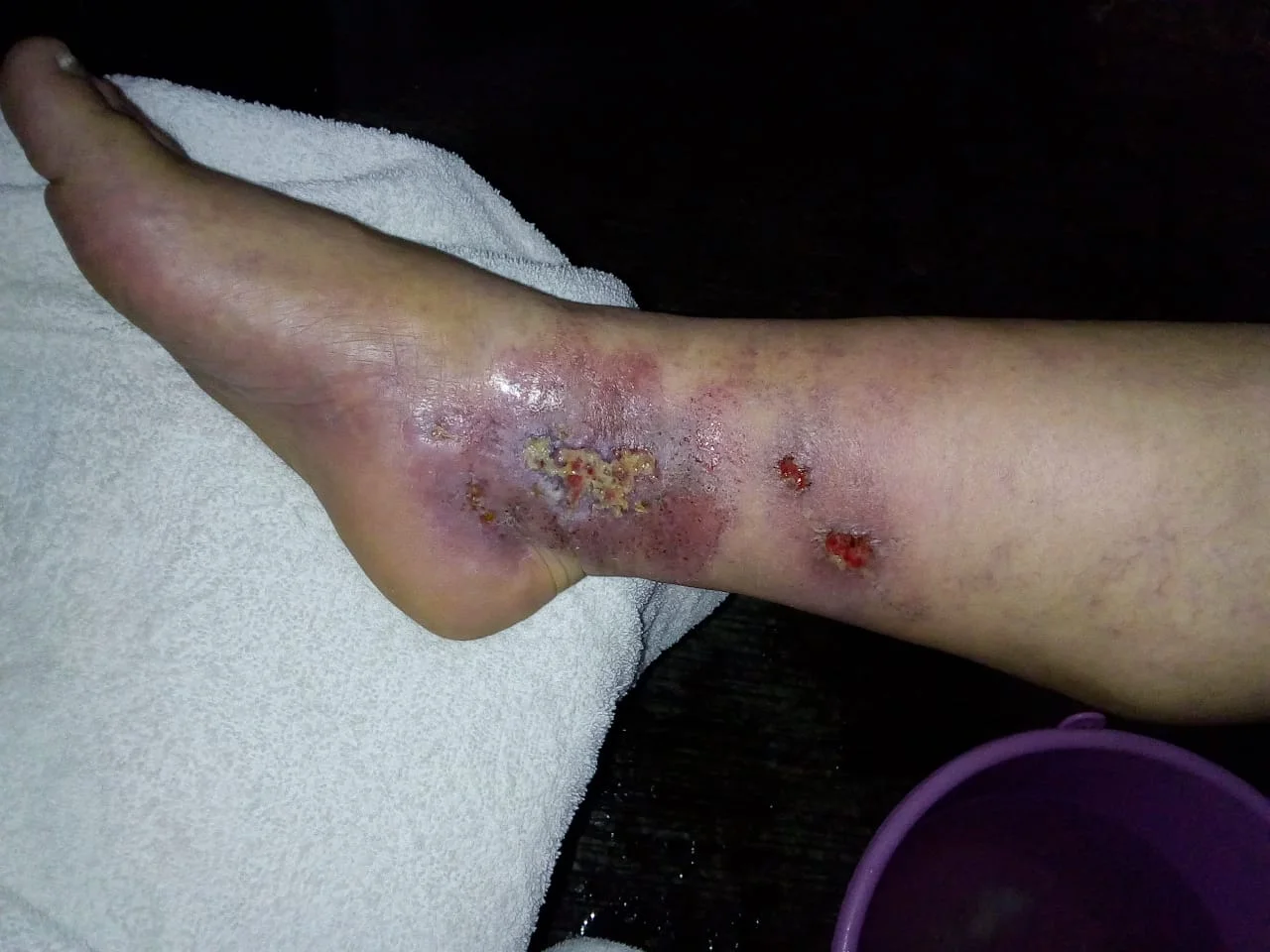 Caso de piel con afectación en pie diabético antes de iniciar rutina de cuidado