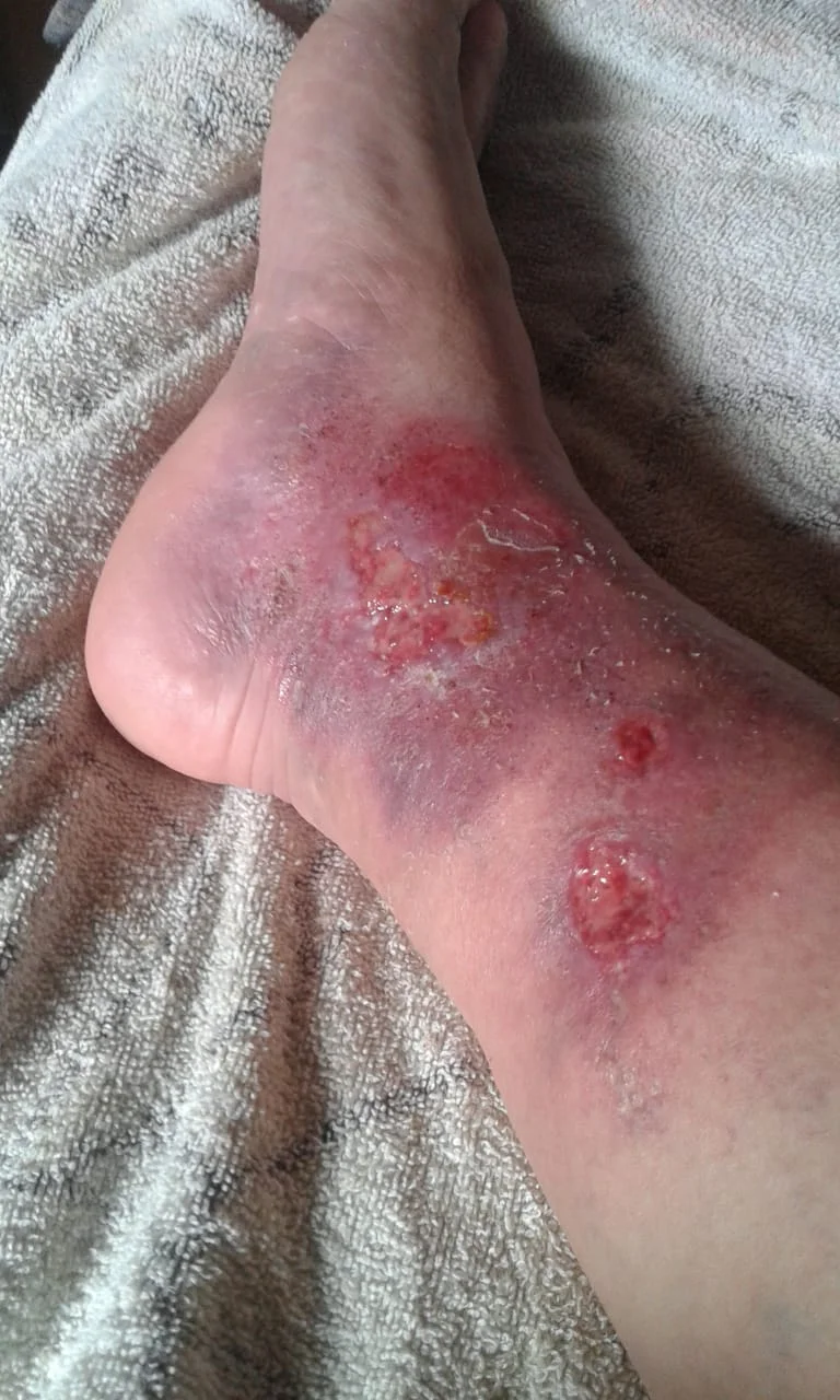 Evolución de piel en pie diabético después de 15 días de cuidado con gel DermaCare MX