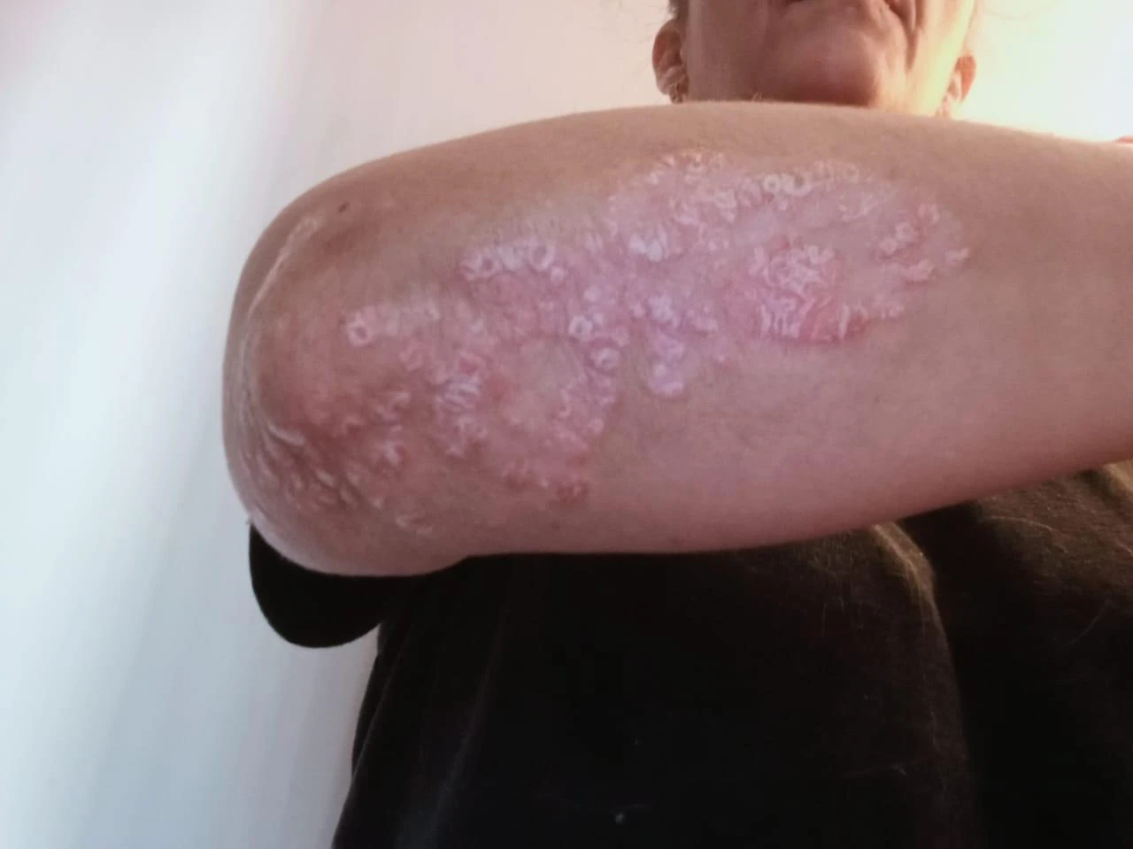 Condición inicial documentada de psoriasis