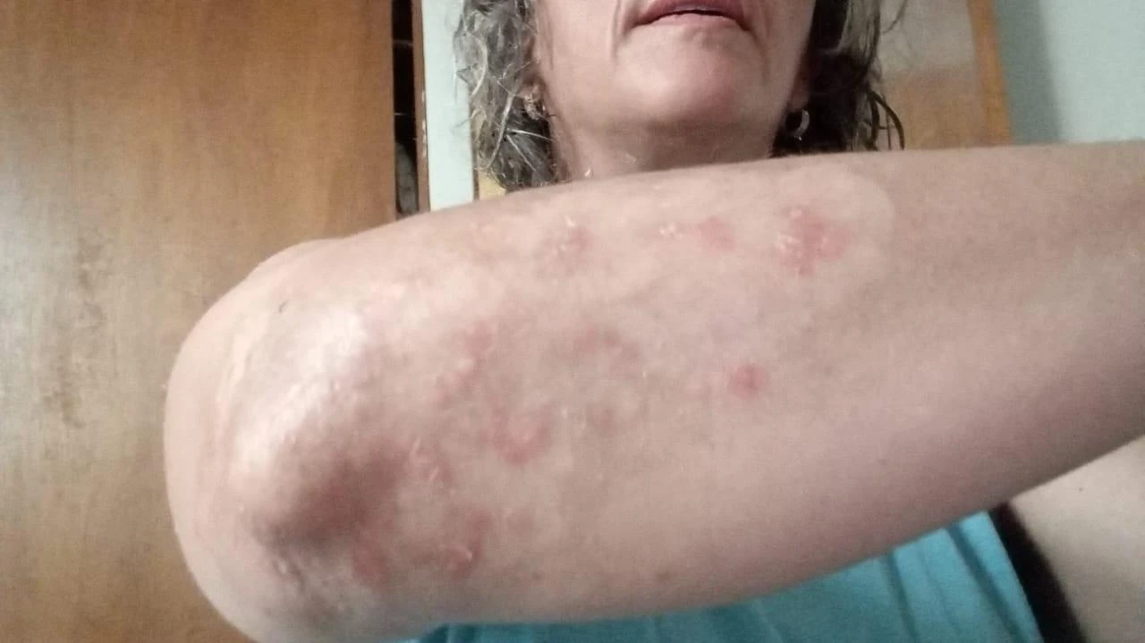 Resultado observado a los 35 días en caso documentado de psoriasis